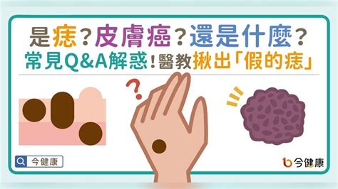 痣長毛代表什麼|是痣？皮膚癌？還是什麼？常見Q&A解惑！醫教揪出「。